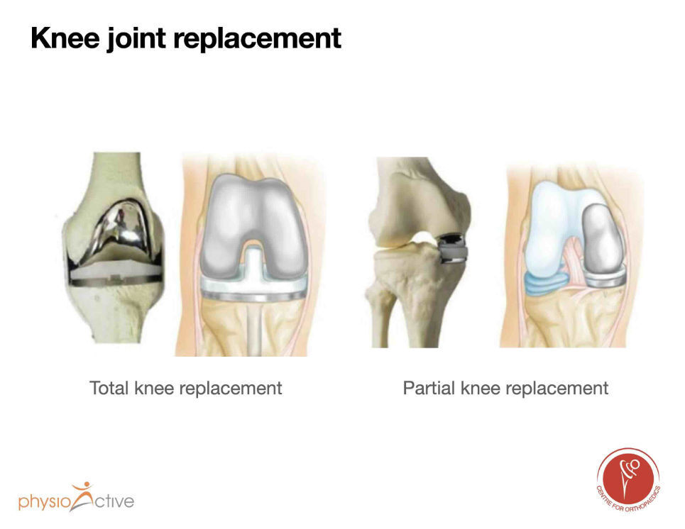 knee joint replacement