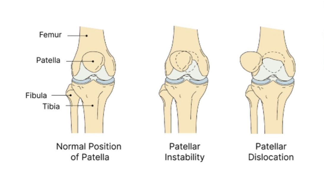 patella instability Dr Lingaraj — normal position, patellar instability and dislocation diagram