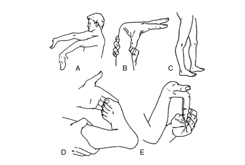 Risk factors for recurrent patella instability — ligamentous laxity showing hypermobile joints with higher range of motion