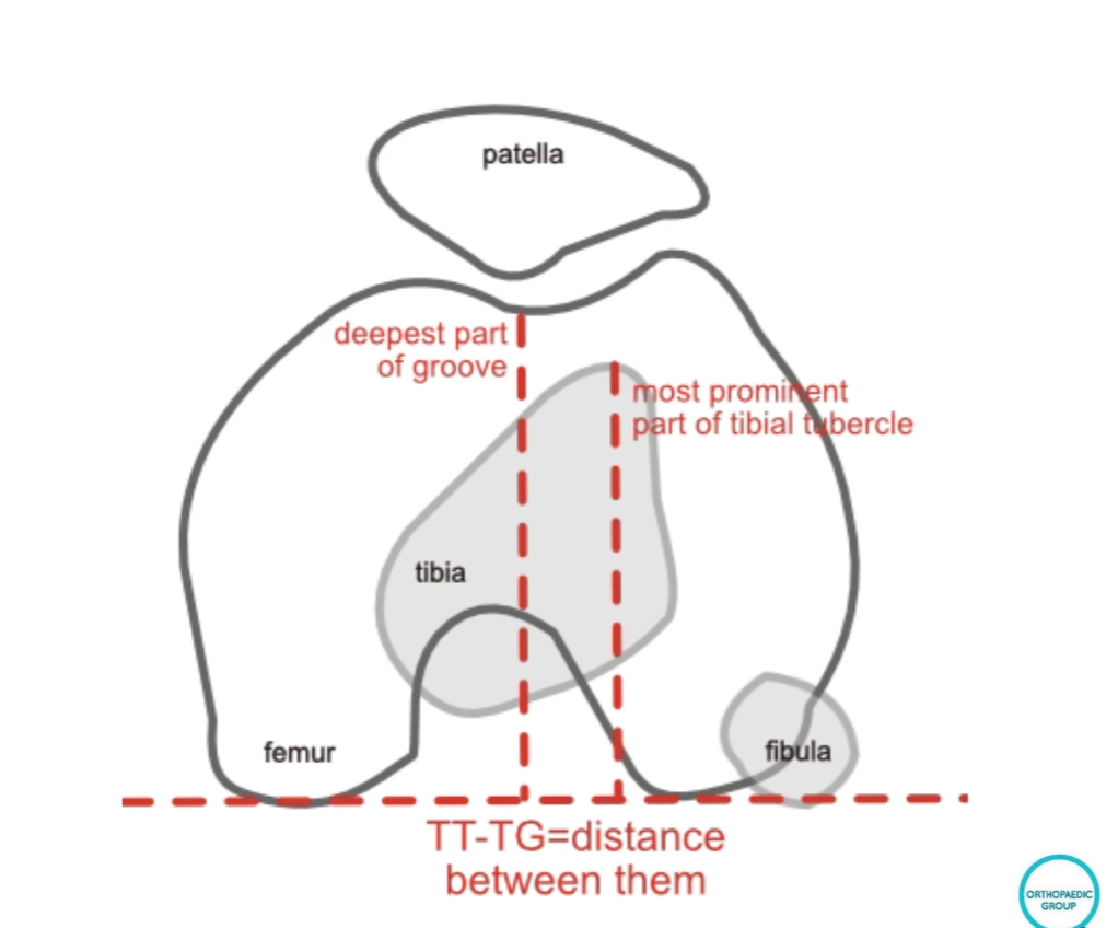 Structural issues in patella instability — TT-TG distance between deepest part of groove and tibial tubercle, showing femur, tibia and fibula